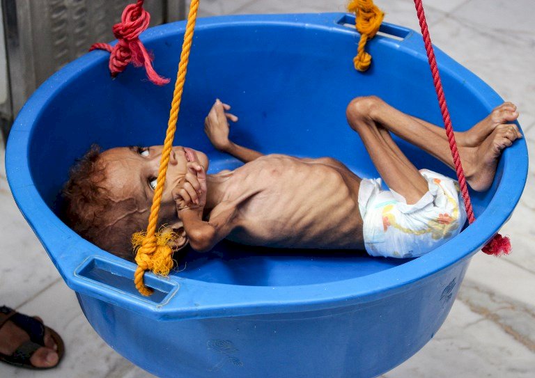 UNICEF: Balita di Yaman Hadapi Kelaparan Selama Masa Pandemi