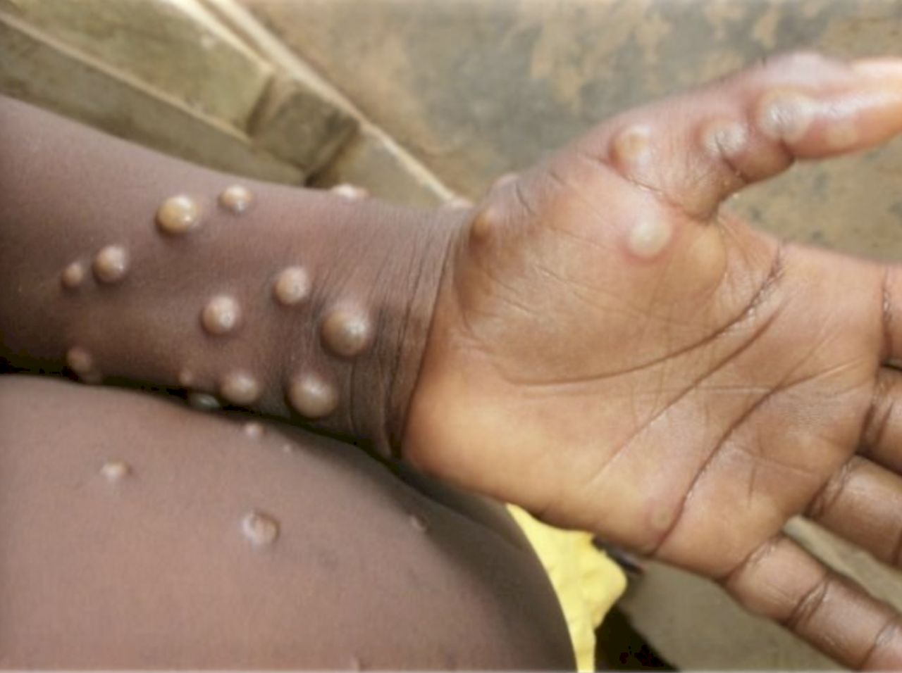 Hindari Stigmatisasi ! WHO Bermaksud Mengubah Nama Virus Monkeypox