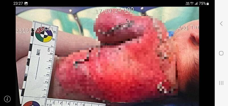 Bayi 3 Bulan Mengalami Luka Bakar Serius, Pusat Penitipan Anak: Tidak Sengaja Menumpahkan Air Panas Saat Membuat Susu.