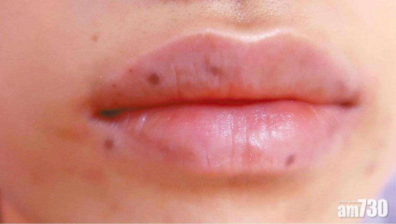 Bintik Hitam Misterius di Bibir Bisa Berubah Menjadi Kanker! Dokter Ungkap Penyebabnya: Mutasi Gen