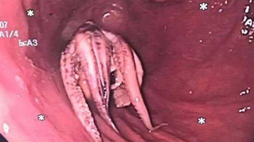 Pria Alami Kesulitan Menelan, Dokter Temukan