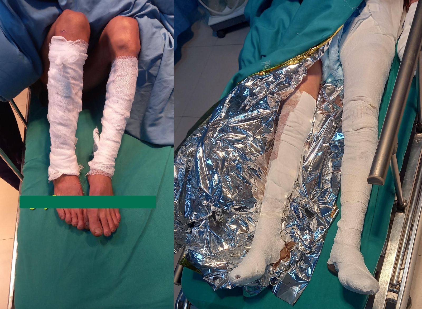 這對夫妻全身嚴重燒傷，雙腳用紗布包紮，避免感染。（圖／翻攝自雄王醫院臉書）