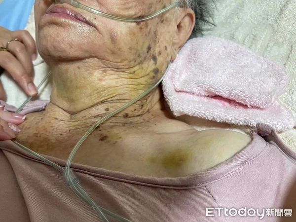 救我,外勞掐我」 苗栗9旬嬤遭看護施暴全身瘀青!家屬怒報警| ETtoday社會新聞| ETtoday新聞雲