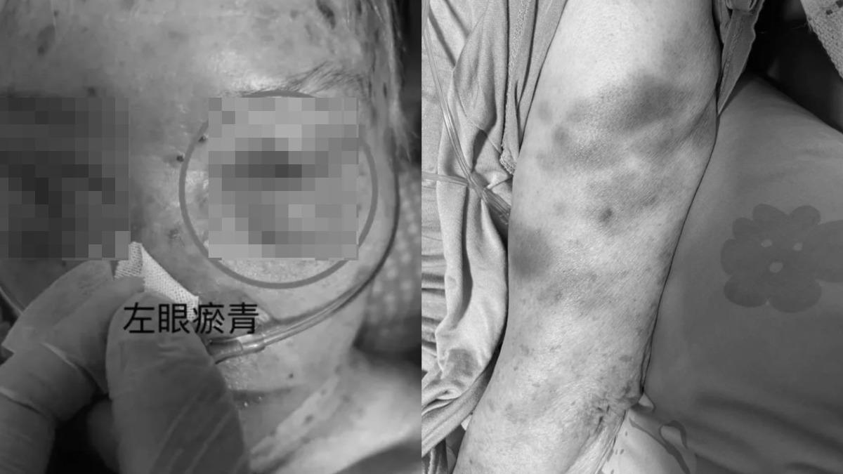 阿嬤被外籍移工虐待,全身多處瘀青。(圖/翻攝自Dcard)